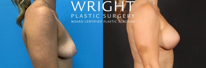 Before & After Breast Augmentation Case 508 Right Side View in Little Rock, Arkansas