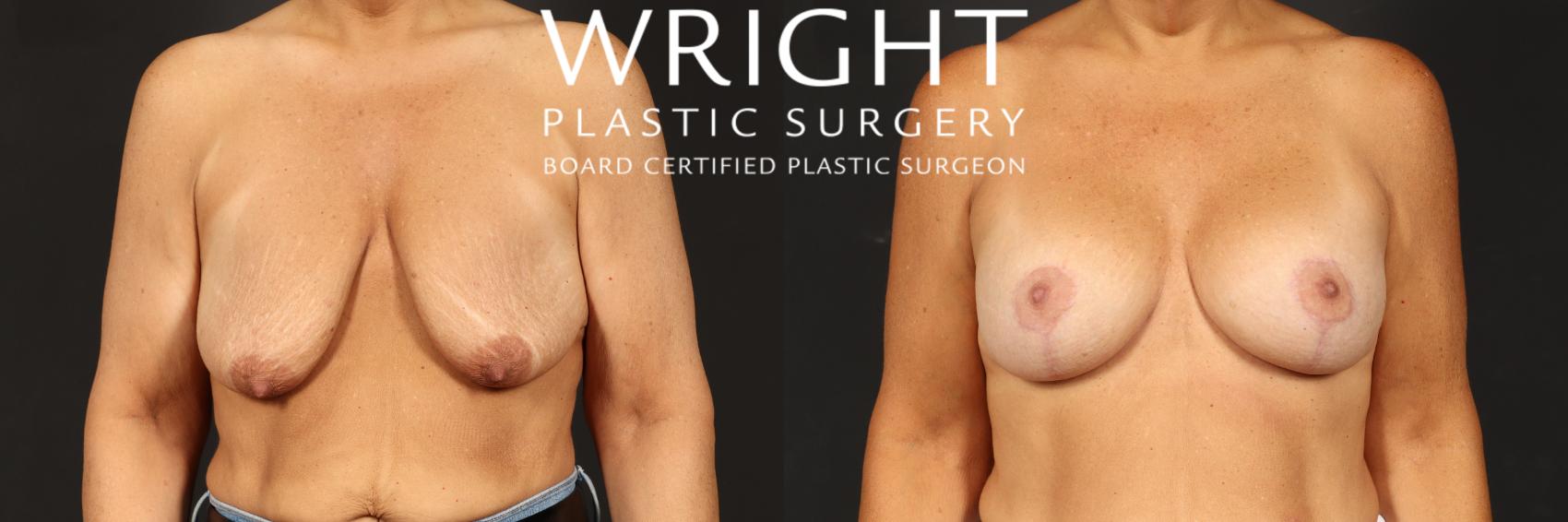 Before & After Breast Augmentation Case 509 Front View in Little Rock, Arkansas