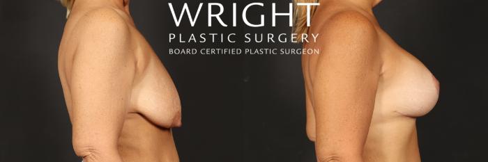 Before & After Breast Augmentation Case 509 Right Side View in Little Rock, Arkansas