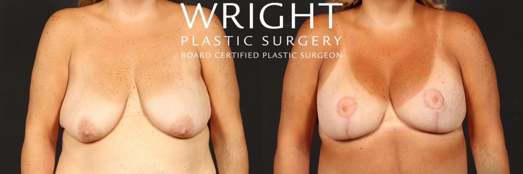 Before & After Breast Lift Case 514 Front View in Little Rock, Arkansas