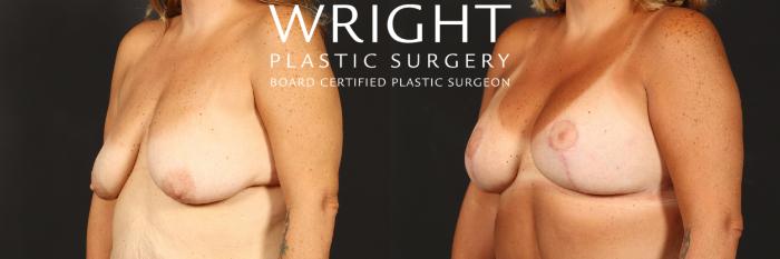 Before & After Breast Lift Case 514 Left Oblique View in Little Rock, Arkansas