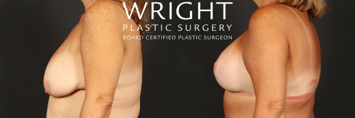 Before & After Breast Lift Case 514 Left Side View in Little Rock, Arkansas