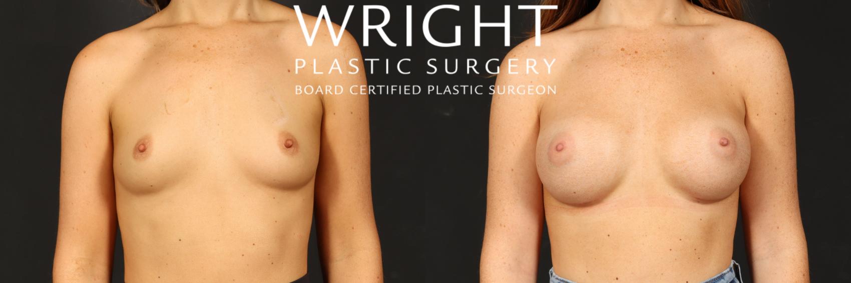 Before & After Breast Augmentation Case 523 Front View in Little Rock, Arkansas