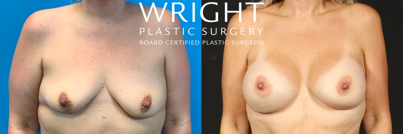 Before & After Breast Augmentation Case 534 Front View in Little Rock, Arkansas