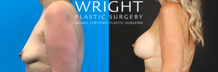 Before & After Breast Augmentation Case 534 Left Side View in Little Rock, Arkansas