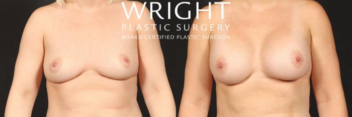 Before & After Breast Augmentation Case 538 Front View in Little Rock, Arkansas