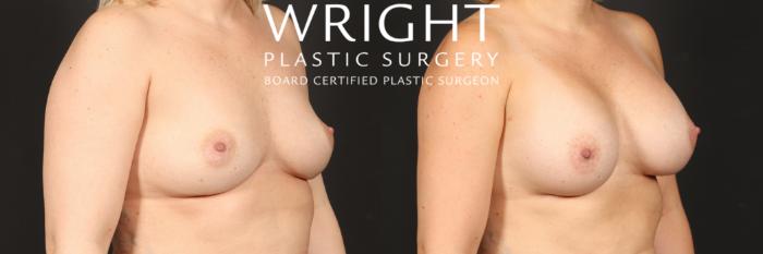 Before & After Breast Augmentation Case 538 Right Oblique View in Little Rock, Arkansas