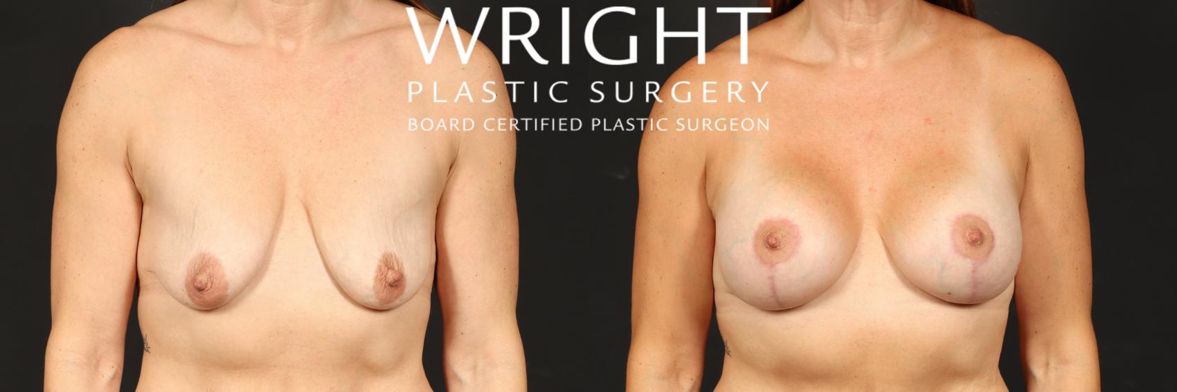 Before & After Breast Augmentation Case 546 Front View in Little Rock, Arkansas