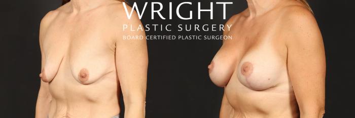 Before & After Breast Augmentation Case 546 Left Oblique View in Little Rock, Arkansas