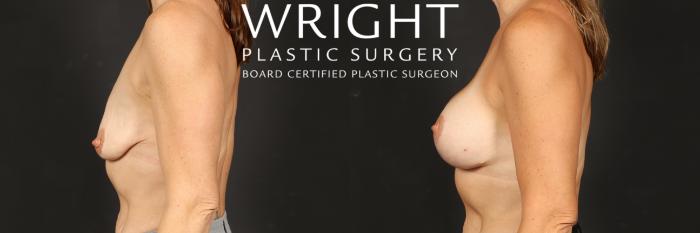 Before & After Breast Augmentation Case 546 Left Side View in Little Rock, Arkansas