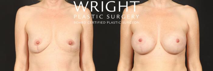 Before & After Breast Augmentation Case 548 Front View in Little Rock, Arkansas