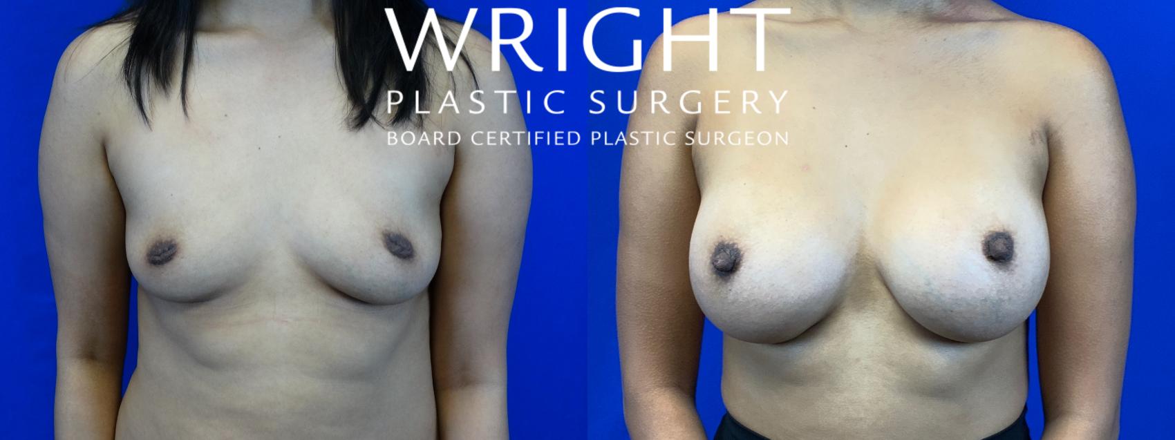 Before & After Breast Augmentation Case 55 Front View in Little Rock, Arkansas