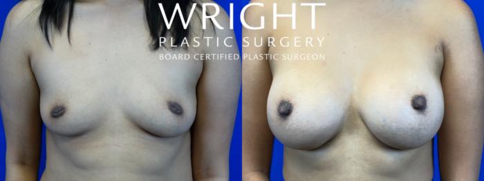 Before & After Breast Augmentation Case 55 Front View in Little Rock, Arkansas