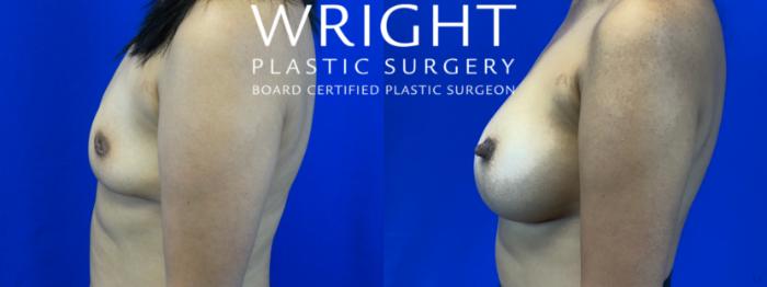 Before & After Breast Augmentation Case 55 Left Side View in Little Rock, Arkansas