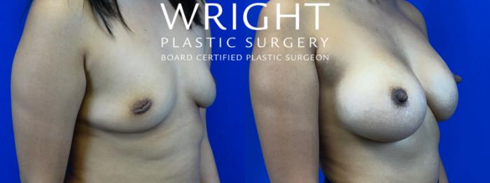 Before & After Breast Augmentation Case 55 Right Oblique View in Little Rock, Arkansas