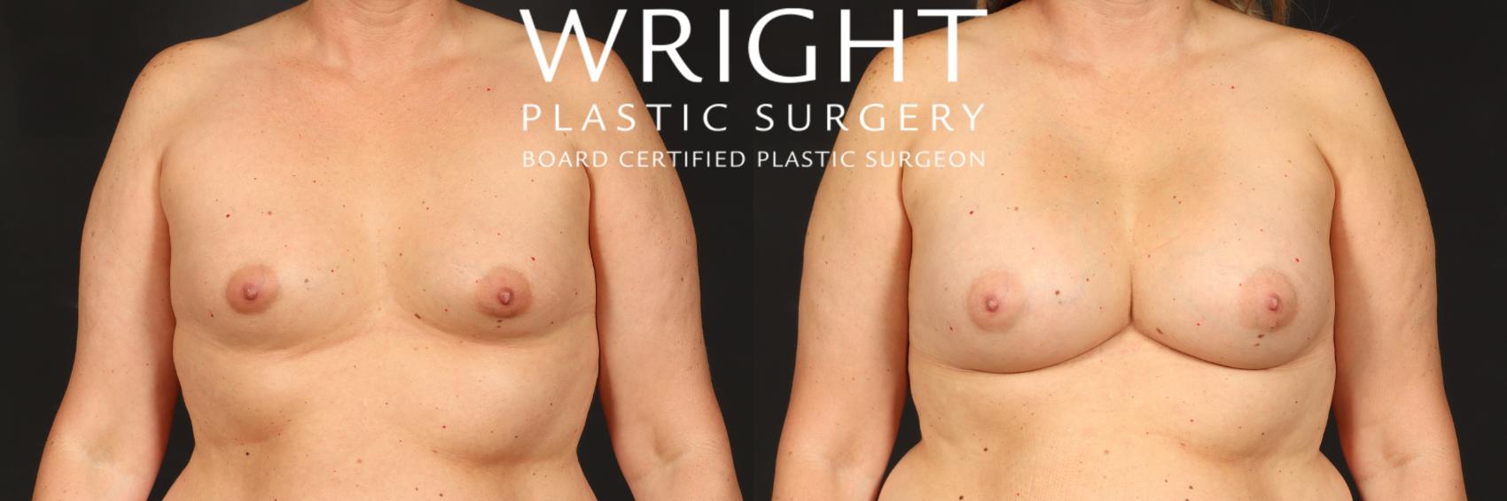 Before & After Breast Augmentation Case 556 Front View in Little Rock, Arkansas