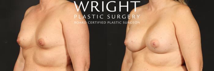 Before & After Breast Augmentation Case 556 Left Oblique View in Little Rock, Arkansas