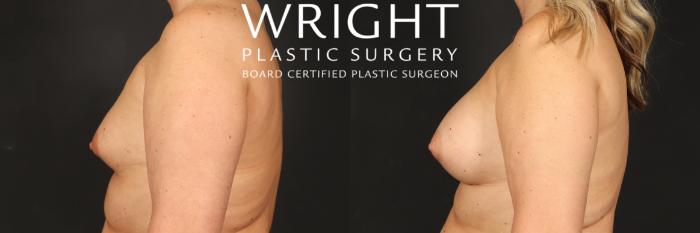 Before & After Breast Augmentation Case 556 Left Side View in Little Rock, Arkansas