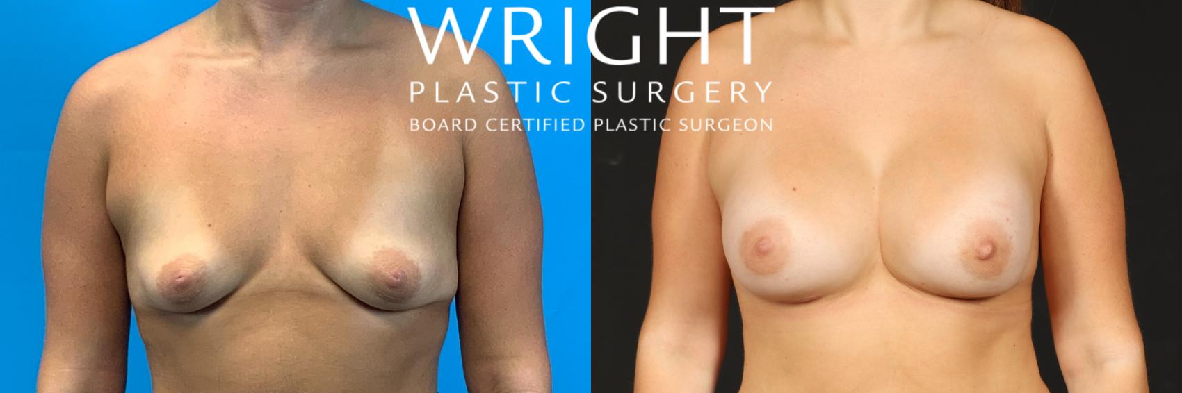 Before & After Breast Augmentation Case 562 Front View in Little Rock, Arkansas