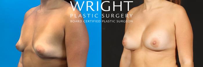 Before & After Breast Augmentation Case 562 Left Oblique View in Little Rock, Arkansas