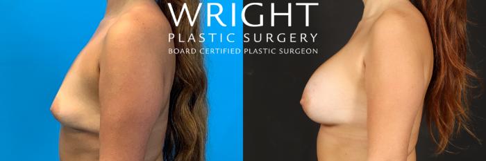 Before & After Breast Augmentation Case 562 Left Side View in Little Rock, Arkansas