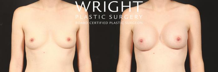 Before & After Breast Augmentation Case 572 Front View in Little Rock, Arkansas