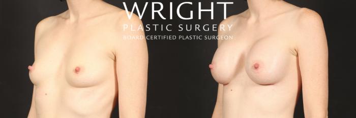 Before & After Breast Augmentation Case 572 Left Oblique View in Little Rock, Arkansas