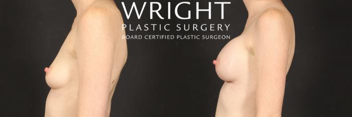 Before & After Breast Augmentation Case 572 Left Side View in Little Rock, Arkansas