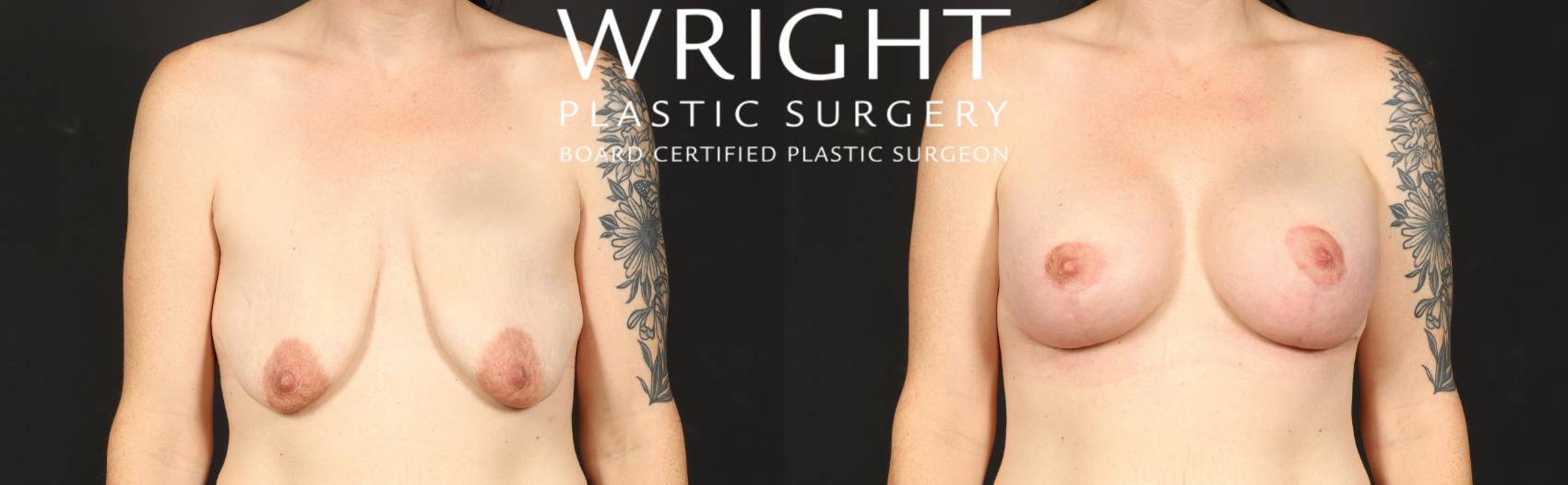 Before & After Breast Augmentation Case 575 Front View in Little Rock, Arkansas