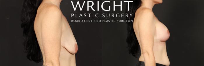 Before & After Breast Augmentation Case 575 Right Side View in Little Rock, Arkansas