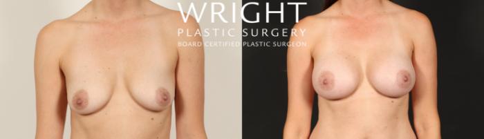 Before & After Breast Augmentation Case 576 Front View in Little Rock, Arkansas