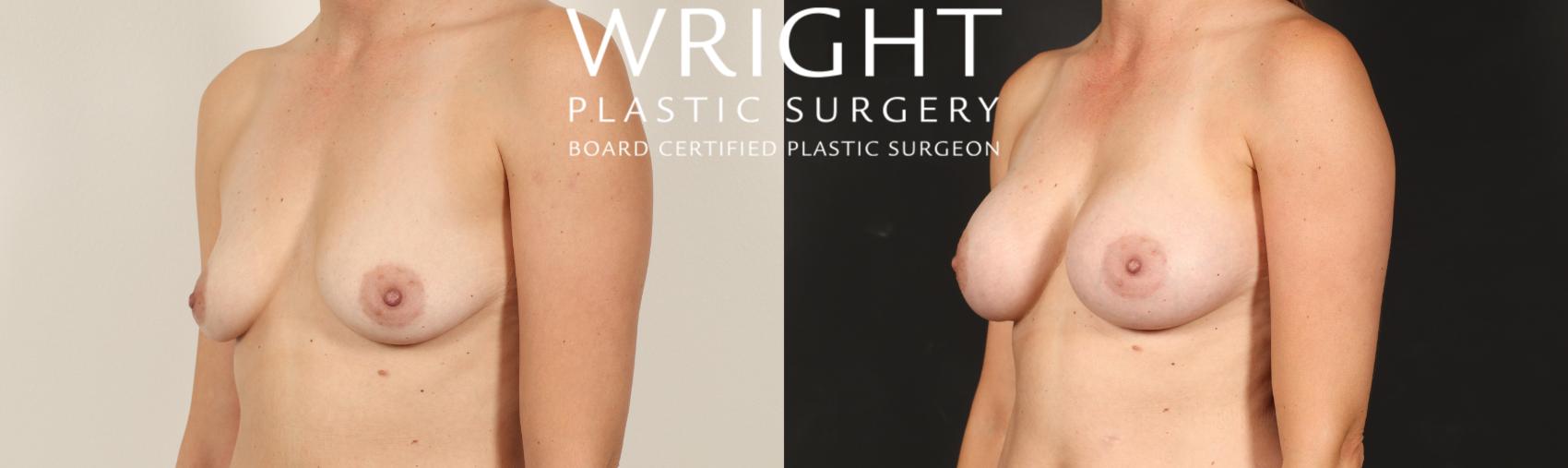 Before & After Breast Augmentation Case 576 Left Oblique View in Little Rock, Arkansas
