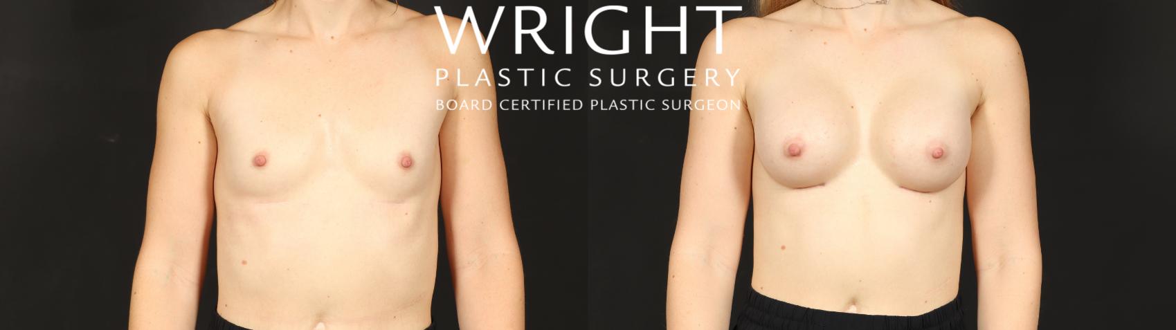 Before & After Breast Augmentation Case 596 Front View in Little Rock, Arkansas