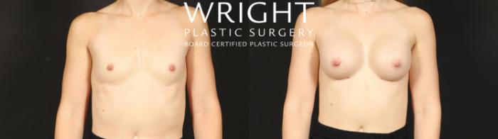 Before & After Breast Augmentation Case 596 Front View in Little Rock, Arkansas