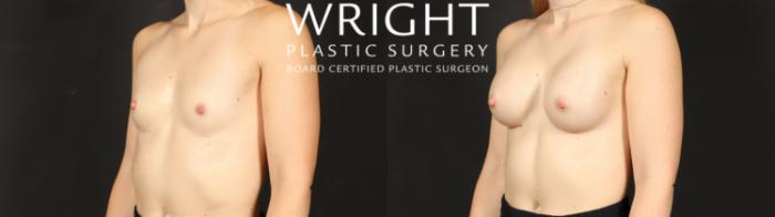 Before & After Breast Augmentation Case 596 Left Oblique View in Little Rock, Arkansas