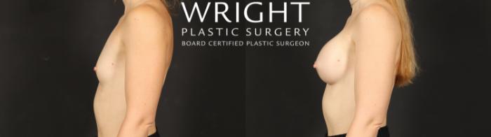 Before & After Breast Augmentation Case 596 Left Side View in Little Rock, Arkansas