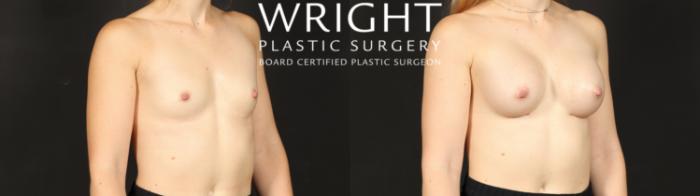 Before & After Breast Augmentation Case 596 Right Oblique View in Little Rock, Arkansas