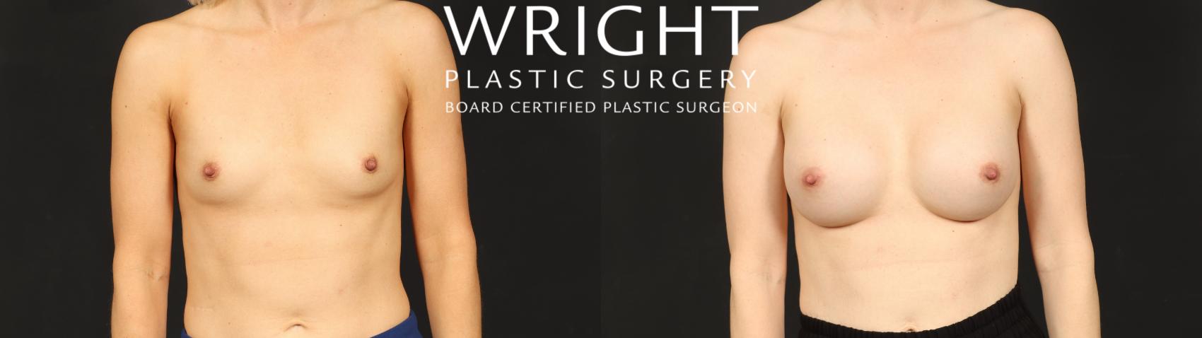 Before & After Breast Augmentation Case 606 Front View in Little Rock, Arkansas