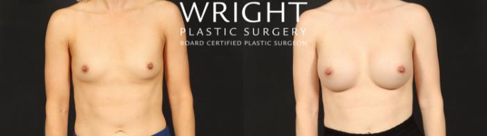 Before & After Breast Augmentation Case 606 Front View in Little Rock, Arkansas