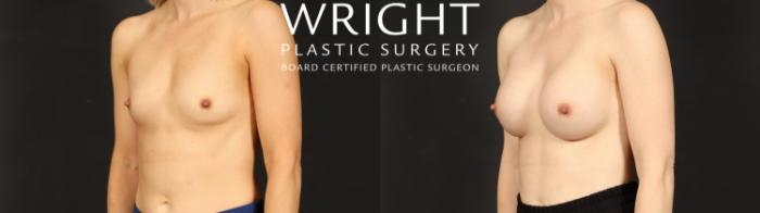 Before & After Breast Augmentation Case 606 Left Oblique View in Little Rock, Arkansas