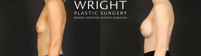 Before & After Breast Augmentation Case 606 Left Side View in Little Rock, Arkansas