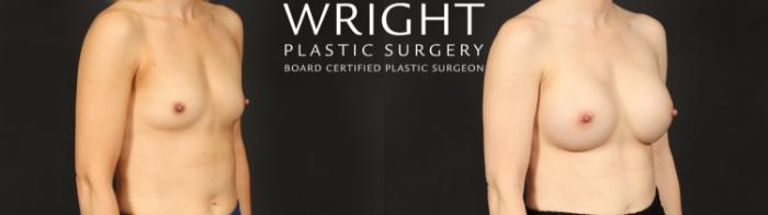 Before & After Breast Augmentation Case 606 Right Oblique View in Little Rock, Arkansas
