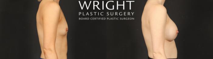 Before & After Breast Augmentation Case 606 Right Side View in Little Rock, Arkansas