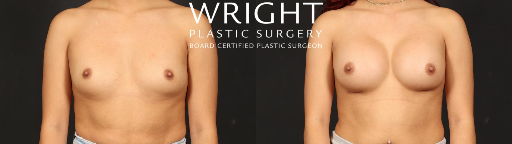Before & After Breast Augmentation Case 608 Front View in Little Rock, Arkansas