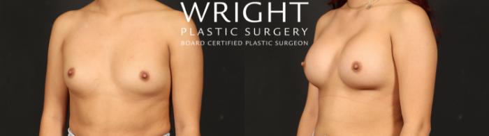 Before & After Breast Augmentation Case 608 Left Oblique View in Little Rock, Arkansas