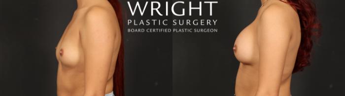 Before & After Breast Augmentation Case 608 Left Side View in Little Rock, Arkansas