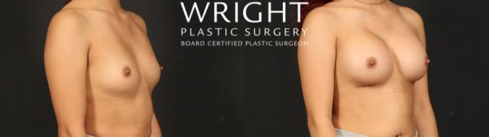 Before & After Breast Augmentation Case 608 Right Oblique View in Little Rock, Arkansas