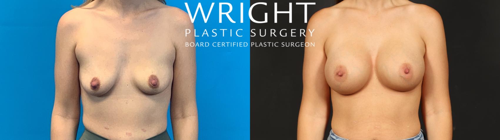Before & After Breast Augmentation Case 637 Front View in Little Rock, Arkansas