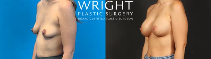 Before & After Breast Augmentation Case 637 Left Oblique View in Little Rock, Arkansas