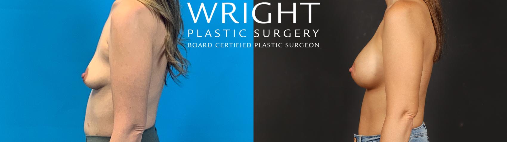 Before & After Breast Augmentation Case 637 Left Side View in Little Rock, Arkansas